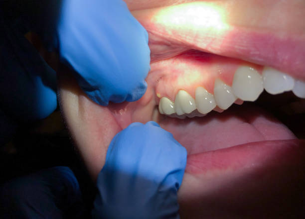 Best Broken or Chipped Tooth Repair in Brookings, SD