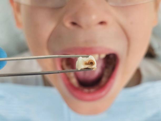 Best Emergency Root Canal Therapy in Brookings, SD